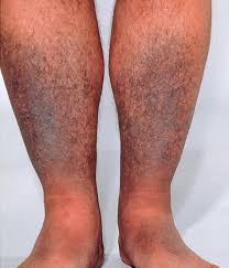 Image result for Diffuse Hyperpigmentation