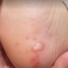 Bahia Noticias Saude Noticia Dermatologistas Identificam Pelo Menos Cinco Manifestacoes Do Coronavirus Na Pele 01 05 2020