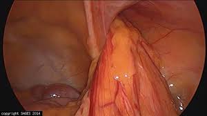 The second surgery left me with a wound vac for a month. Hernia Tags Sages