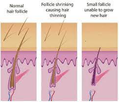 It is a very common cause. Hair And Hair Loss Hair Today Gone Tomorrow How Does Hair Grow What Is Hair Loss What Causes Hair Loss