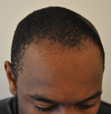 We do not recommend combing while your hair is dry. A Great Hair Loss Treatment For Black Men His Hair Clinic