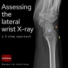 Image result for Wrist XRay