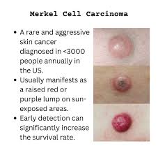 Image result for Merkel Cell Carcinoma