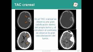 El aneurisma es una zona débil en la pared de un vaso sanguíneo que provoca que éste sobresalga o se abombe. Neurorgs Net Asociacion De Aneurisma Cerebral Y Meningioma Youtube