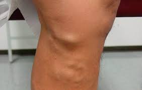 Venous thrombosis is thrombosis in a vein, caused by a thrombus (blood clot). Dr Lozano Balderas Tratamiento De Trombosis Venosa Profunda