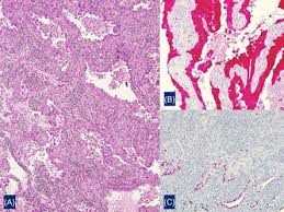 Biopsy, a procedure to remove a small portion of tissue for laboratory examination, is the only way to determine whether you have mesothelioma. Insert The Dark Side Of Mesothelioma Sciencedirect