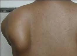 Image result for Scapulothoracic Injection