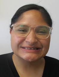 Hipodontia, congenital absence of some teeth because of agenesis vs  Oligodontia that refers to numerous congenitally missing teeth.