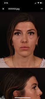 Blepharoplasty Support Group