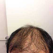 Heredity, hormones, and age all play a part. Could Minoxidil 5 Be Causing Extreme Hair Shedding 7 Months After Fue Hair Transplant Photo