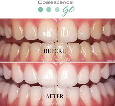 It's ready to use right out of the box; Teeth Whitening With Opalescence Smile Care Dental Center
