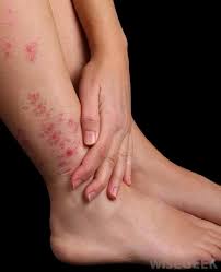 Check spelling or type a new query. What Is Nummular Eczema With Pictures