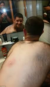 Disgusting Moment A Man Squeezes A Huge Ingrown Hair On His Friend S Back Daily Mail Online