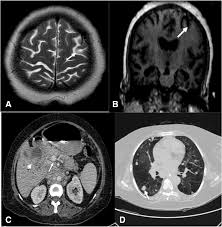 Around 80% to 90% of patients diagnosed with bladder cancer have this symptom. Atypical Frontal Lobe Seizure As The First Manifestation Of Gall Bladder Cancer A Case Report Bmc Neurology Full Text