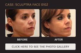 Safety and effectiveness of sculptra® aesthetic have not been evaluated in areas other than nasolabial wrinkles and folds in clinical trials. Sculptra Injections In Houston Katy Body By Ravi