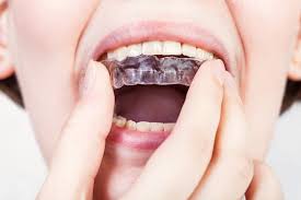 If you are currently wearing a night guard for bruxism, also known as teeth grinding, it is important that you take care of it correctly. Splints For Teeth Grinding Mouth Guard Treatment