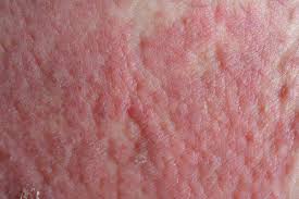Image result for Atopic Dermatitis