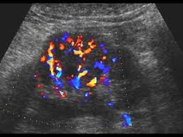 46 years experience internal medicine. Urinary Tract And Male Reproductive System 2 1 Kidney And Ureter Case 2 1 2 Benign Renal Tumors Renal Reproductive System Urinary Tract