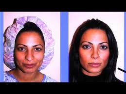 Rhinoplasty