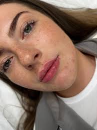 Enhancing lips isn't about chasing size, it's about balance, symmetry &  harmony with your natural features. A skilled injector doesn't just fill  lips. They sculpt, refine & tailor results to you. 👄✨