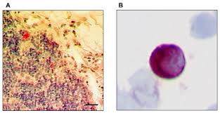 Bone marrow cancer, also known as myeloma, is a severe form of cancer that usually affects people over 60 years, and is among the 20 most common cancer types in the uk. Cancers Free Full Text Lymph Node And Bone Marrow Micrometastases Define The Prognosis Of Patients With Pn0 Esophageal Cancer