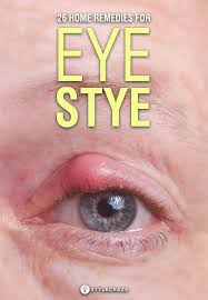 26 Effective Home Remedies To Get Rid Of Eye Stye Eye Stye Remedies Stye Treatment Stye Remedy