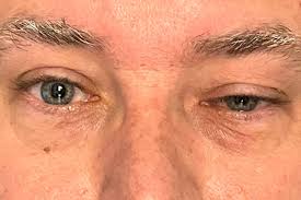 Image result for Ice Pack Test