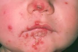 Impetigo - Nhs