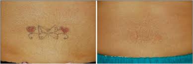 Dermatologists, tattoo removal, laser hair removal. Laser Tattoo Removal Newark Remove Tattoos Hockessin