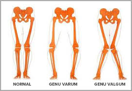 Une semelle orthopédique sur mesure. Comment Soulager Allo Podo