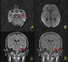 Learn more about the disease, plus 4 steps to help manage symptoms. Cureus Guillain Barre Syndrome Following A Snakebite A Case Report And Review Of Literature