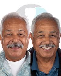 From missing teeth to a full, confident smile — this amazing All-on-X case  by Dr. Jorge Manríquez shows what's possible with modern implant dentures.  💪🦷 . No more flippers, no more loose