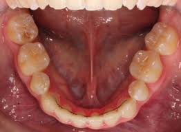 1.) floss threaders are thin plastic needles that are used to help direct floss between the teeth and under your permanent wire. Retainers Rainier Valley Orthodontics
