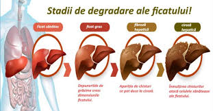 Hepatita C Tratament Corect Si Modalitati De Transmitere In 2020 Liver Detox Fatty Liver Fatty Liver Symptoms