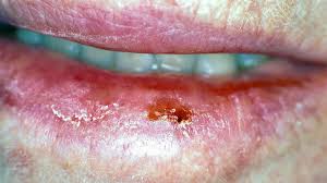 Image result for Lip Cancer