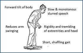 Parkinson's symptoms usually begin gradually and get worse over time. Blog Parkinson S Disease