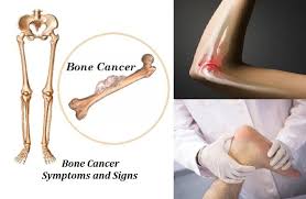 To learn how to talk to your doctor about the different stages of bone. Diponed Biointelligence Signs And Symptoms Of Bone Cancer Diponed Biointelligence