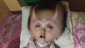 Wo befindet sich die abteilung fur haushaltsartikel? Seltene Fehlbildung Hydranencephalie Mutter Kampft Um Baby Mit Teufelshornern