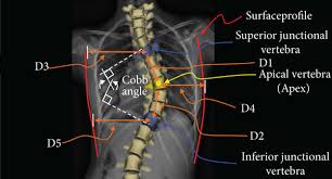 Steps in designing the scoliosis analog model. (a) Coronal plane data,... |  Download Scientific Diagram