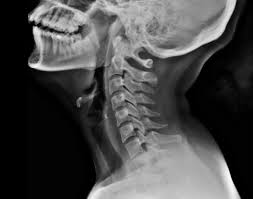 Ponticulus Posticus Radiology Case Radiopaedia Org