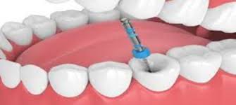 Your dentist will investigate more to confirm the source of the pain. Gbj Unv6nji3om