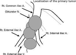 Image result for Primary Tumor Localization