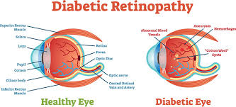 The location is great, the hotel has a cool design and the. Diabetic Retinopathy First Eye Care Irving