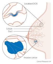 There are many different types of breast cancer. Pre Invasive