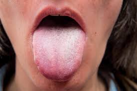 Image result for Puchýře na jazyku