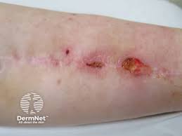 Image result for Skin Ulcer