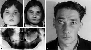 Familial cherubism: the experience of the Moscow Central Institute for  Stomatology and Maxillo-Facial Surgery