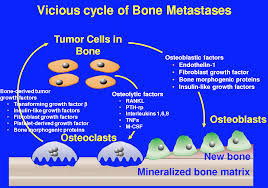 Pin On Cancer Metastasis