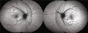 Apmppe primarily affects healthy young. Acute Posterior Multifocal Placoid Pigment Epitheliopathy Eyewiki
