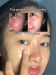 IT'S NOT JUST ABOUT MOISTURIZER ✨ Soalnya moist ini udah nolongin aku  banget 💚 #dorskin #matchaglowdreammask #acnefighter